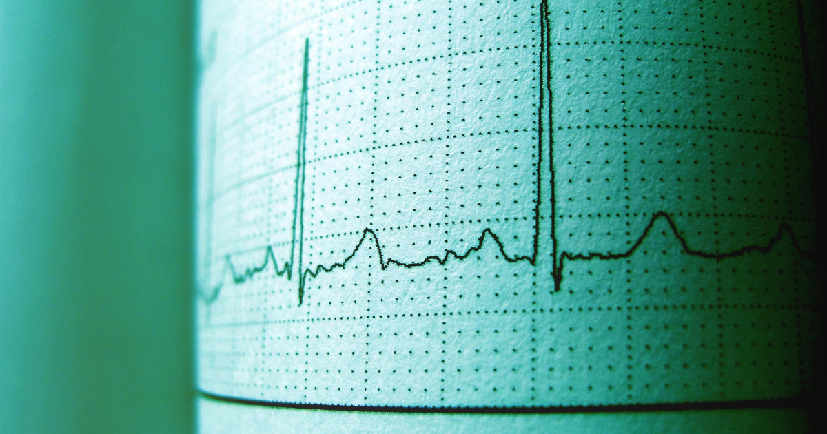 EKG showing heart rhythm. Recognizing methadone overdose symptoms; heart rate irregularities may indicate overdose.