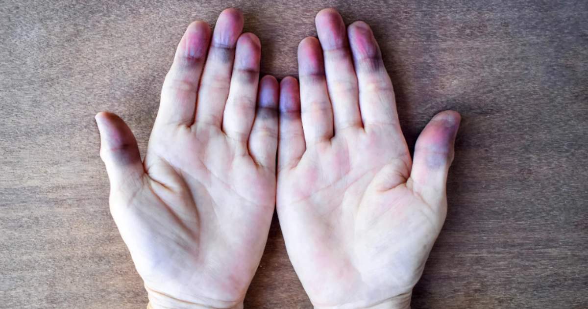 Methadone overdose symptom: Cyanosis, or blue fingertips, can indicate a lack of oxygen and requires immediate medical attention.